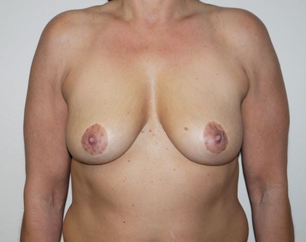 Before Image: Breast Lift with Augmentation - front