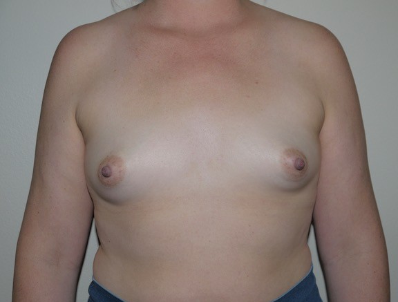 Before Image: Breast Augmentation - front