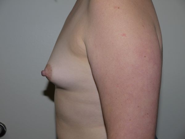 Before Image: Breast Augmentation - left-side