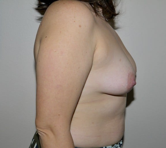 Before Image: Breast Lift with Augmentation - right-side