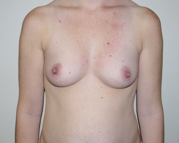 Before Image: Breast Augmentation - front