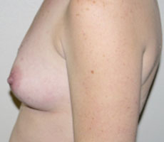Before Image: Breast Augmentation - left-side