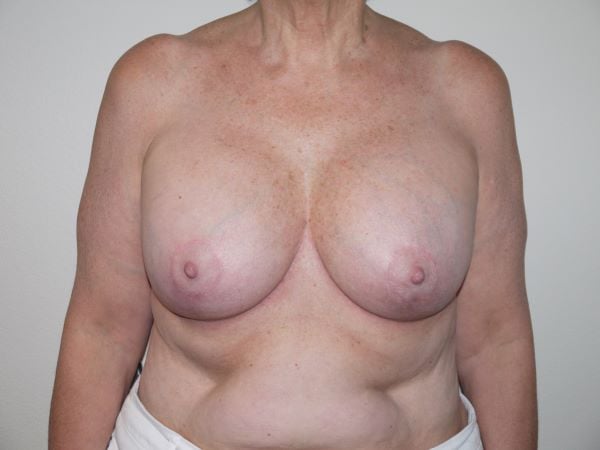 After Image: Breast Implant Revision - front