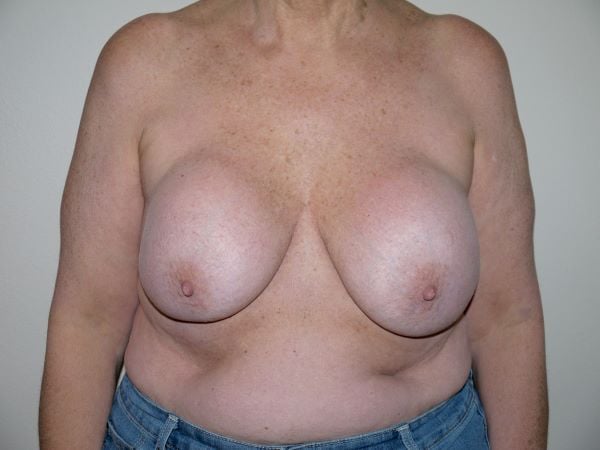 Before Image: Breast Implant Revision - front