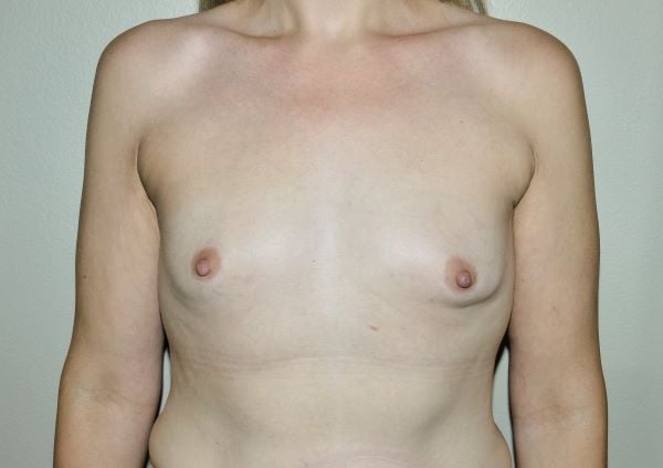 Before Image: Breast Augmentation - front