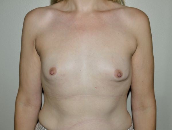 Before Image: Breast Augmentation - front