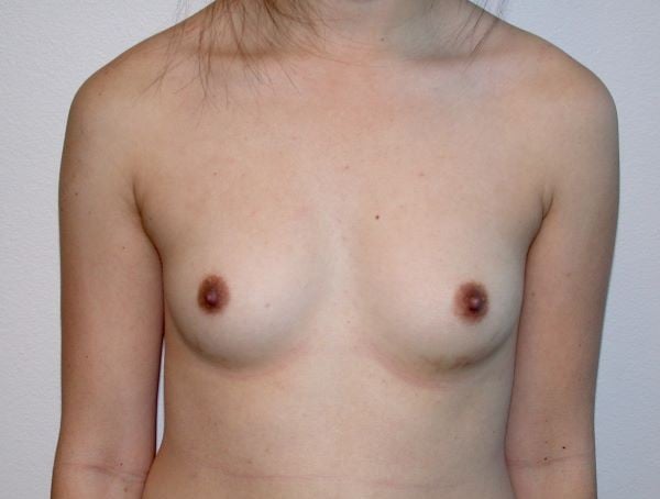 Before Image: Breast Augmentation - front