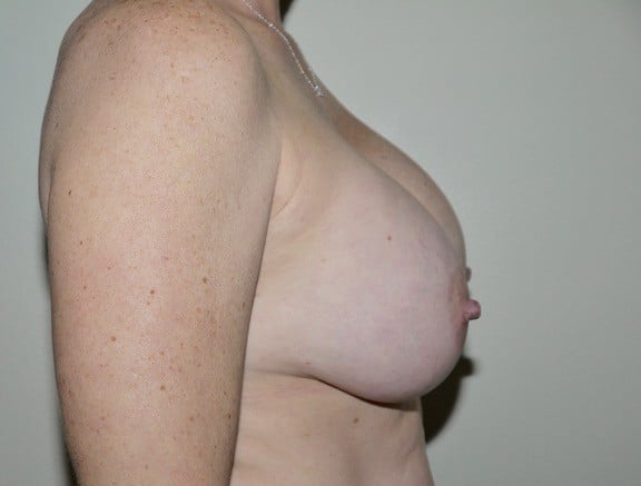 Before Image: Breast Implant Removal with Lift - right-side