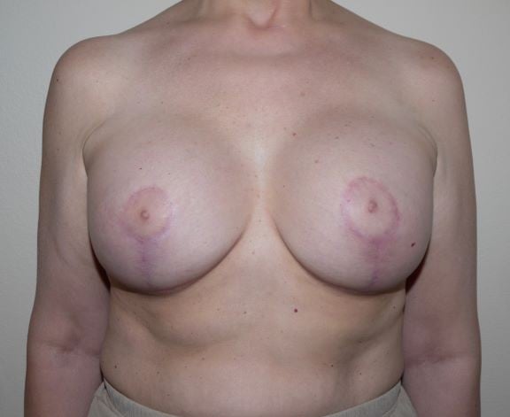 After Image: Breast Implant Revision - front