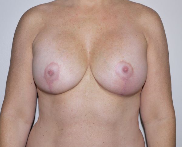 After Image: Breast Implant Revision - front
