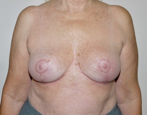 After Image: Breast Implant Removal with Lift - front