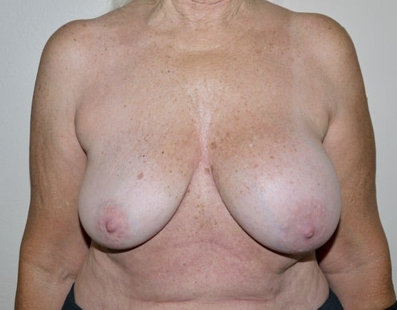 Before Image: Breast Implant Removal with Lift - front
