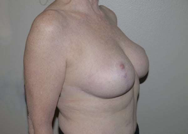 After Image: Breast Implant Removal with Lift - right-front-oblique