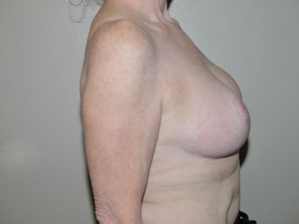 After Image: Breast Implant Removal with Lift - right-side