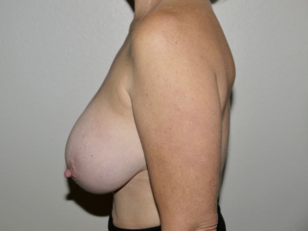 Before Image: Breast Implant Removal with Lift - left-side