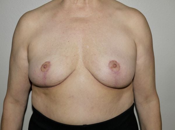 After Image: Breast Implant Removal with Lift - front