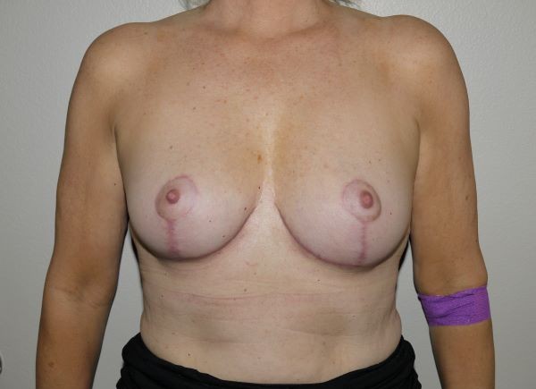 After Image: Breast Implant Removal with Lift - front