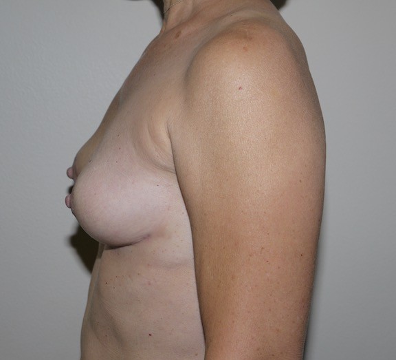 After Image: Breast Implant Removal with Lift - left-side