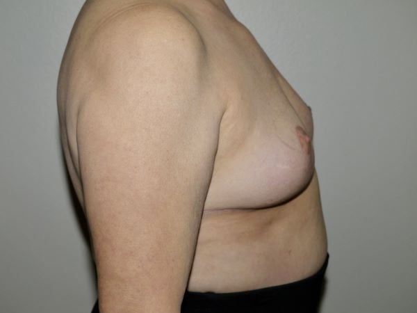 After Image: Breast Implant Removal with Lift - right-side