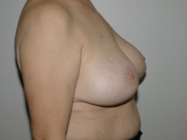 Before Image: Breast Implant Removal with Lift - right-side