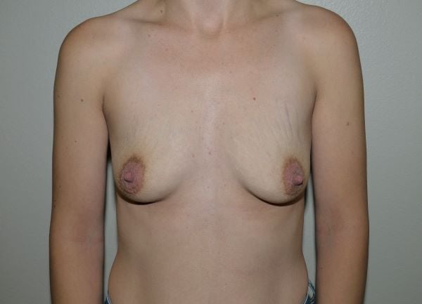 Before Image: Breast Augmentation - front