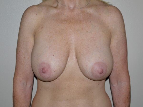 Before Image: Breast Implant Removal with Lift - front