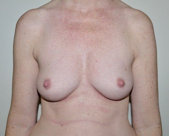 Before Image: Breast Augmentation - front