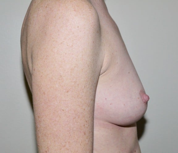 Before Image: Breast Augmentation - right-side