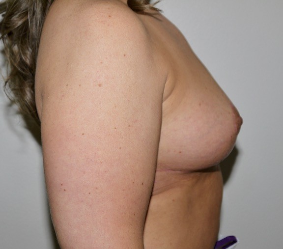 After Image: Breast Implant Removal with Lift - right-side