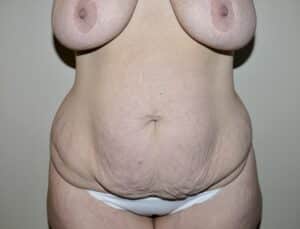 Abdominoplasty