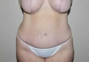Abdominoplasty
