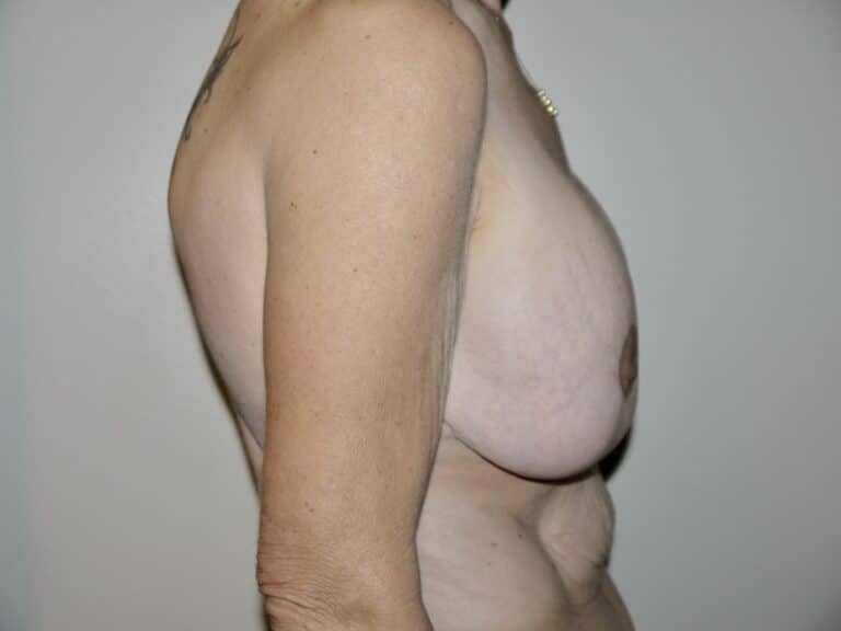 Before Image: Breast Implant Revision - right-side