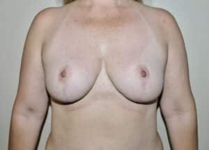 Breast Reduction