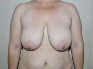 Breast Reduction