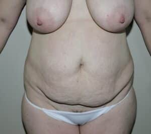 Abdominoplasty