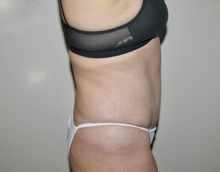 After Image: Abdominoplasty - right-side
