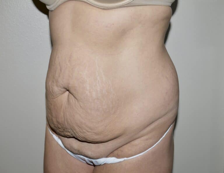 Before Image: Abdominoplasty - left-front-oblique