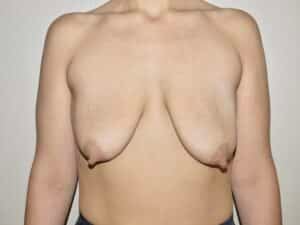 Breast Lift with Augmentation