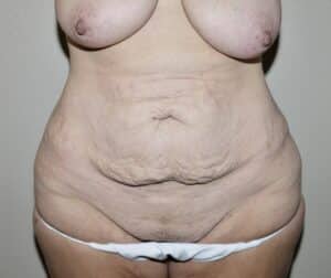 Abdominoplasty