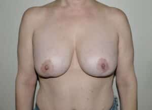 Breast Implant Removal With Lift