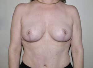 Breast Implant Removal With Lift
