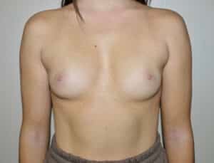 Before Image: Breast Augmentation