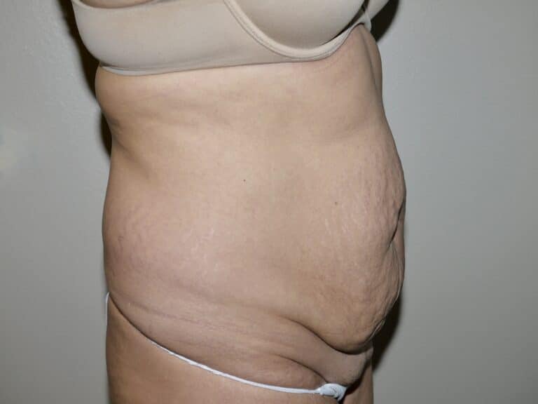 Before Image: Abdominoplasty - right-side