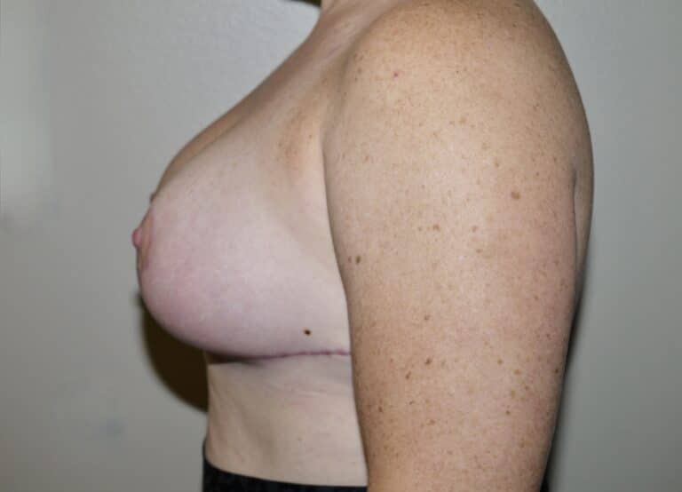 After Image: Breast Lift - left-side