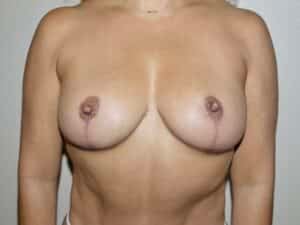 Breast Reduction