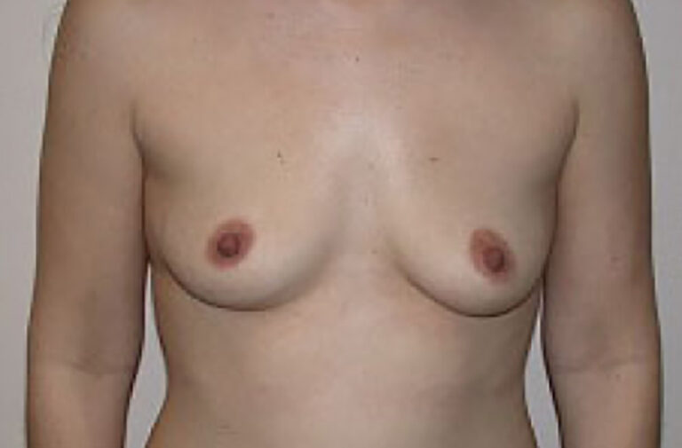 Before Image: Breast Augmentation - front