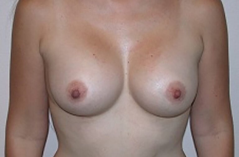 After Image: Breast Augmentation - front