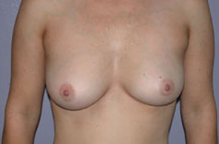 Before Image: Breast Augmentation - front
