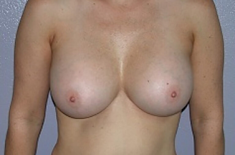 After Image: Breast Augmentation - front