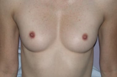Before Image: Breast Augmentation - front